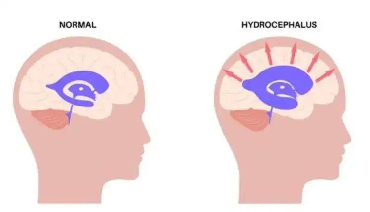 Tempat Pengobatan Hidrocephalus di Bangkinang Terbaik dan Terpercaya