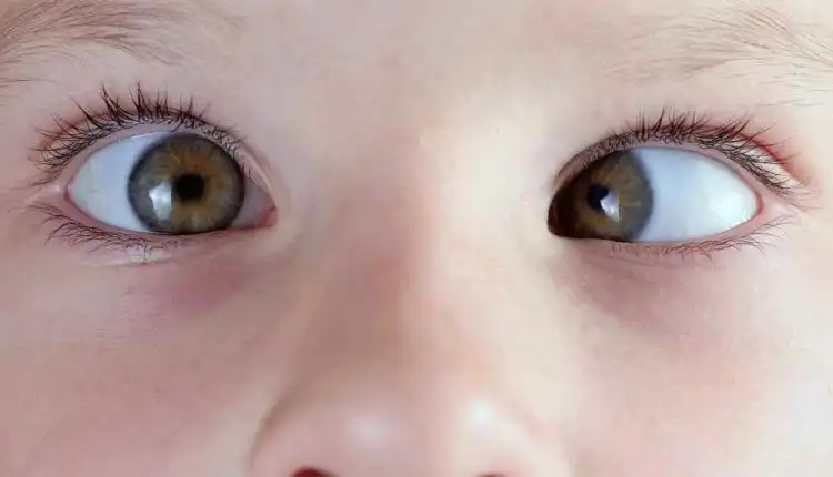 Tempat Pengobatan Mata Juling di Bangkinang Profesional dan Cepat Sembuh