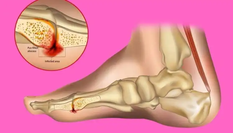 Tempat Pengobatan Osteomielitis di Bangkinang yang Mujarab dan Direkomendasikan