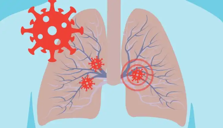 Tempat Pengobatan Paru-Paru Lemah di Bangkinang Profesional dan Terpercaya