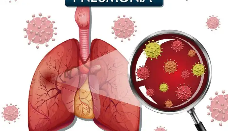 Tempat Pengobatan Pneumonia di Bangkinang Terpercaya dan Profesional
