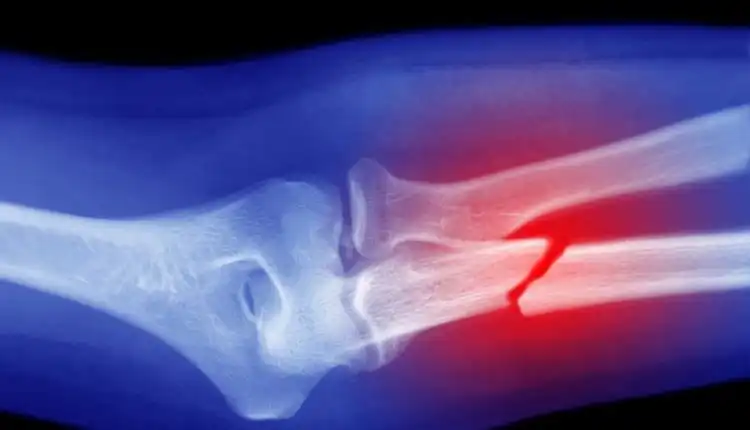 Terapi Patah Tulang di Cibitung Paling Aman Tanpa Efek Samping