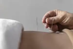 Keajaiban Akupunktur yang Bisa Kamu Rasakan