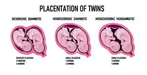 Viral, Bayi Mengandung Kembarannya Sendiri