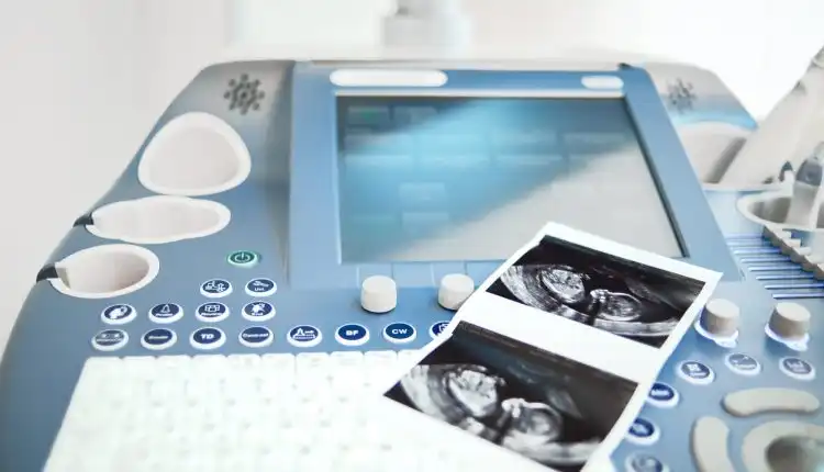 Viral, Bayi Mengandung Kembarannya Sendiri