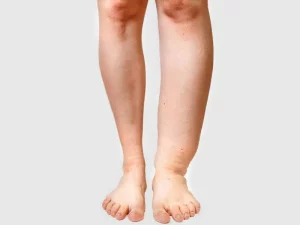 kaki gajah medical hacking