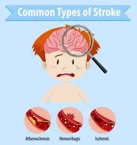 3 Metode Treatment Hadapi Stroke Dari Kisah Nyata Pejuang