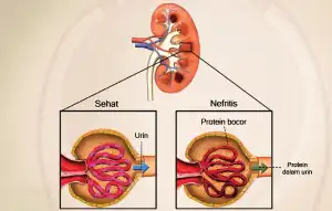 Gara-Gara Tren Minum 2 Botol Sirup Pemuda Ini Bisa Terkena Diabetes Hingga Kanker