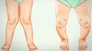 tulang syaraf medhack