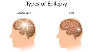 epilepsi medhack