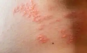 Kenali 8 Penyakit Kulit yang Sering Menyerang Tubuh dan Cara Mengatasinya