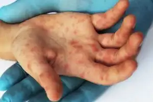 Kenali 8 Penyakit Kulit yang Sering Menyerang Tubuh dan Cara Mengatasinya