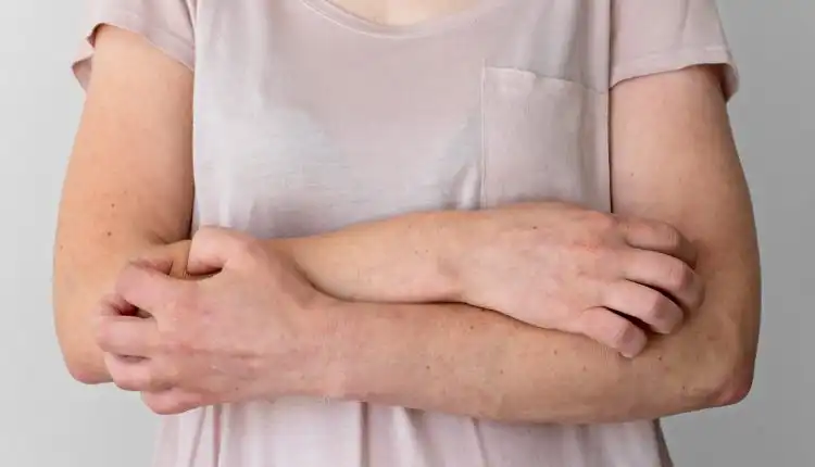 Kenali 8 Penyakit Kulit yang Sering Menyerang Tubuh dan Cara Mengatasinya