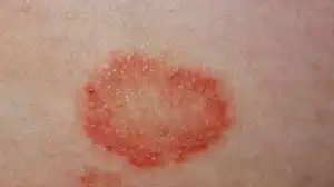 Kenali 8 Penyakit Kulit yang Sering Menyerang Tubuh dan Cara Mengatasinya