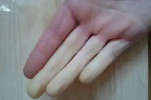 Kenali 8 Penyakit Kulit yang Sering Menyerang Tubuh dan Cara Mengatasinya