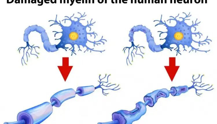 Kenali Kerusakan Mielin yang Dapat Sebabkan Motorik Anak Terganggu