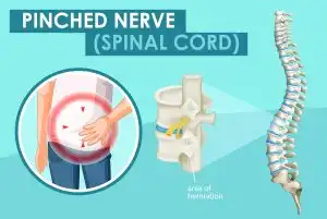 Kisah Ibu Guru Dalam Proses Terapi Syaraf Kejepit