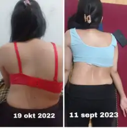 Ternyata Ini Yang Ibu Dapatkan Setelah Terapi Skoliosis