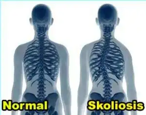 Ternyata Ini Yang Ibu Dapatkan Setelah Terapi Skoliosis
